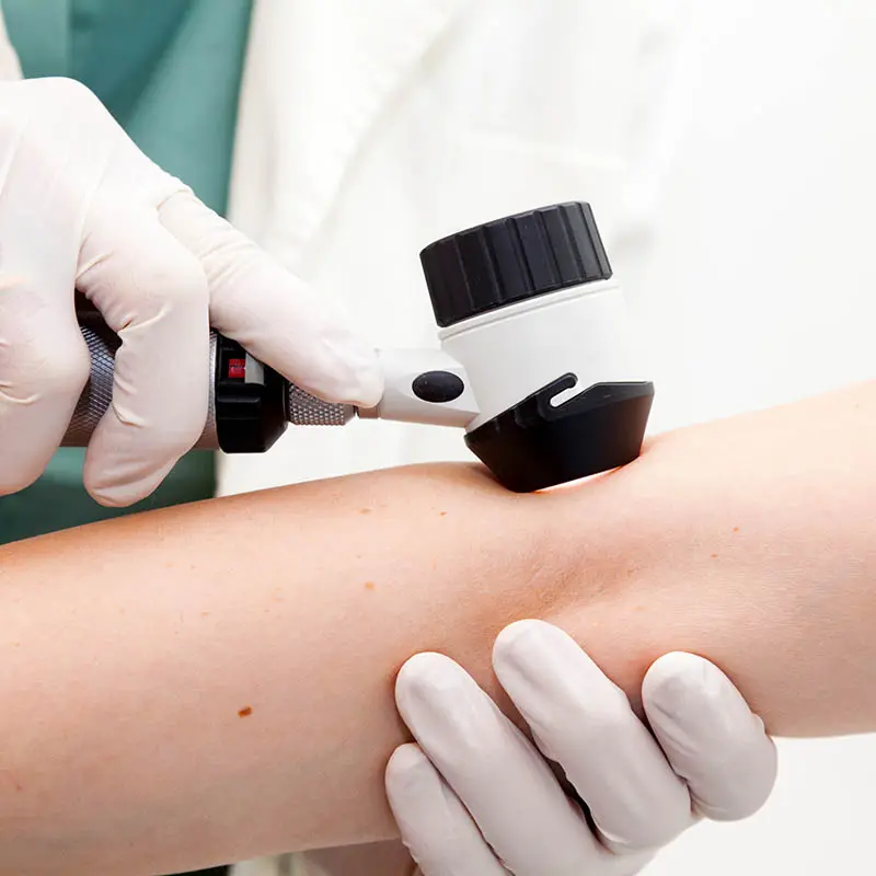 Examen dermatologique au dermatoscope